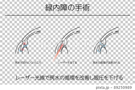 図解、緑内障の手術、メディカルイラスト 図解、緑内障の手術、メディカルイラスト 89250989