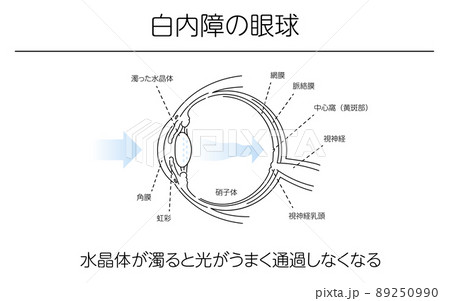 図解、白内障の眼球、メディカルイラスト 89250990