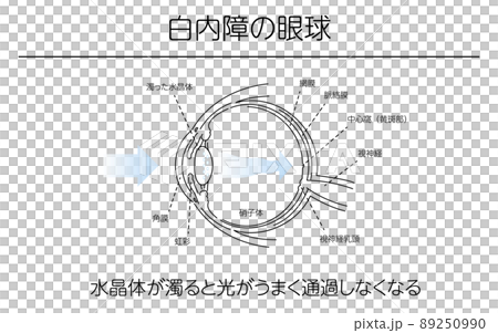 図解、白内障の眼球、メディカルイラスト 89250990