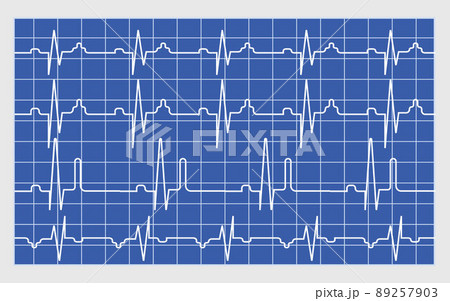 Electrocardiogram scan result vector concept. EKG monitor for emergency. Cardiac test illustration. Heart beat 89257903