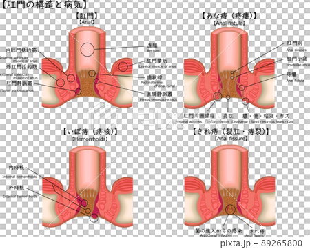Anal hemorrhoids illness illustration Japanese 89265800