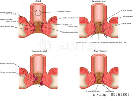 肛門　痔　病気　イラスト　英語 89265802
