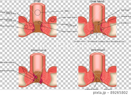 肛門　痔　病気　イラスト　英語 89265802