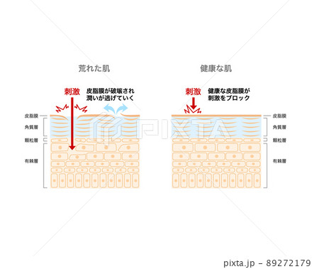 荒れた肌と健康な肌 30日サイクル 荒れた肌と健康な肌 30日サイクル 89272179