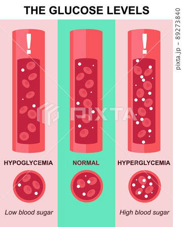 Glucose level test in blood vector lab analysis 89273840