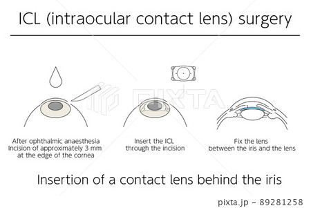 図解、ICL(眼内コンタクトレンズ)による視力矯正、メディカルイラスト 89281258