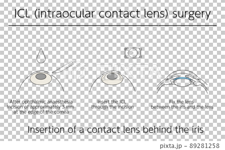 図解、ICL(眼内コンタクトレンズ)による視力矯正、メディカルイラスト 89281258