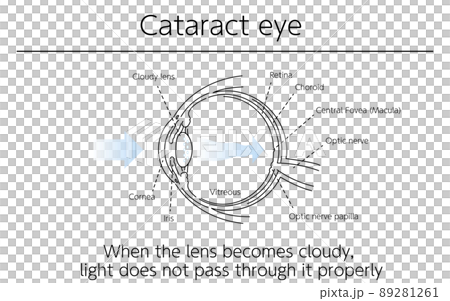 Illustrations, cataract eyeballs, medical illustrations 89281261