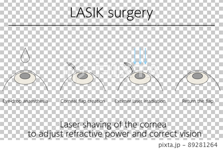 Illustration, LASIK vision correction, medical illustration 89281264