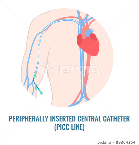 picc catheter