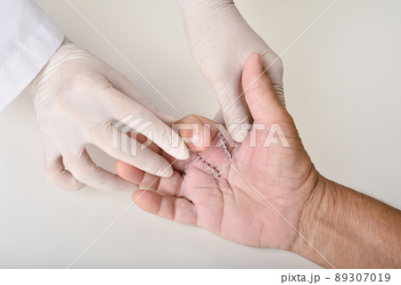Hand surgery treatment, Trigger finger stiffness painful, Doctor treat patient's injury in hospital Hand surgery treatment, Trigger finger stiffness painful, Doctor treat patient's injury in hospital 89307019