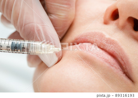 Close up of hands of cosmetologist making botox injection in female lips. Lip shape correction, lip augmentation. 89316193