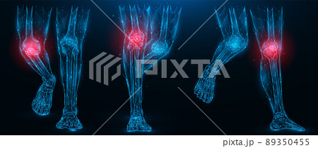 Polygonal vector illustration of human legs, inflammatory disease of the knee joint concept. Low poly art lower limbs on a dark blue background. 89350455