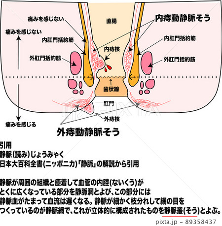 痔のメカニズムと肛門断面イラストと説明図 89358437
