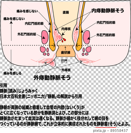 痔のメカニズムと肛門断面イラストと説明図 89358437