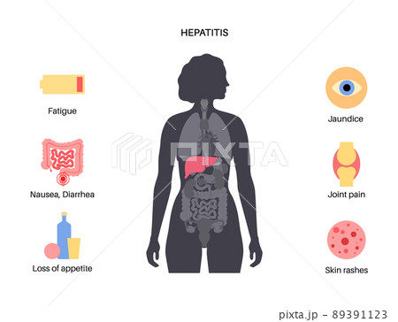 Autoimmune hepatitis disease 89391123