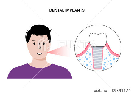 Dental implant procedure 89391124