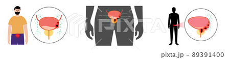 Bladder cancer stages Bladder cancer stages 89391400