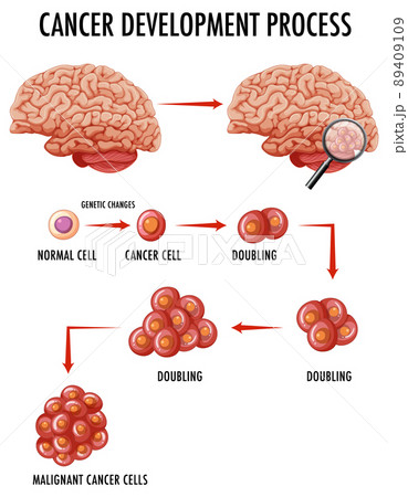 Diagram showing cancer development process Diagram showing cancer development process 89409109