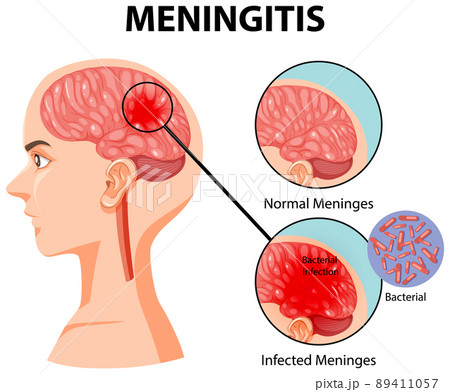 Diagram showing meningitis in human brain Diagram showing meningitis in human brain 89411057