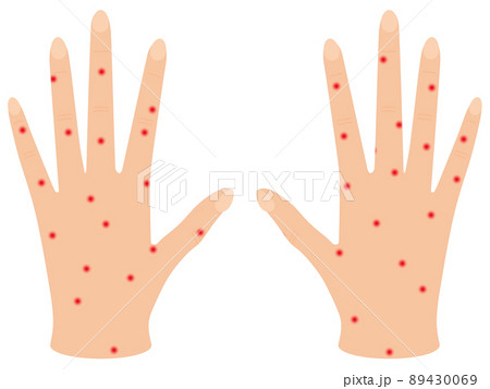蕁麻疹の手 89430069