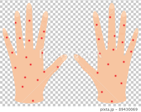 蕁麻疹の手 89430069