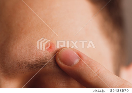 Pimple on the man's forehead above eyebrow. Designated by color close-up 89488670