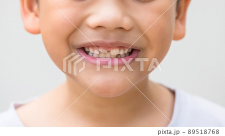 Smilling Asian boy with new upper adult tooth 89518768