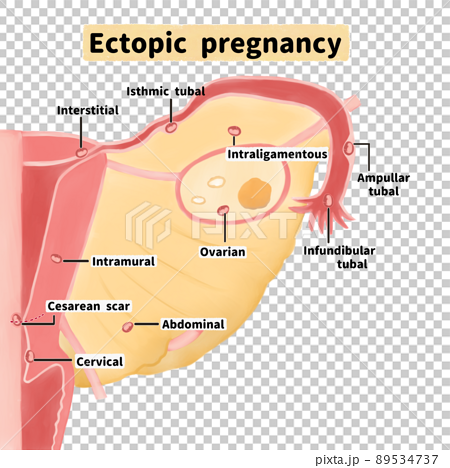 異所性妊娠（子宮外妊娠）の好発部位の図解イラスト　英語 89534737