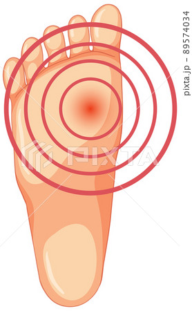 Hallux valgus types on white background 89574034