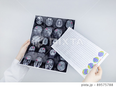 Epileptologist examines patient MRI and electroencephalogram. Concept treating epilepsy and helping people who suffer from this disease. Neurologist at work. Pathology of the brain. Seizure activity Epileptologist examines patient MRI and electroencephalogram. Concept treating epilepsy and helping people who suffer from this disease. Neurologist at work. Pathology of the brain. Seizure activity 89575788