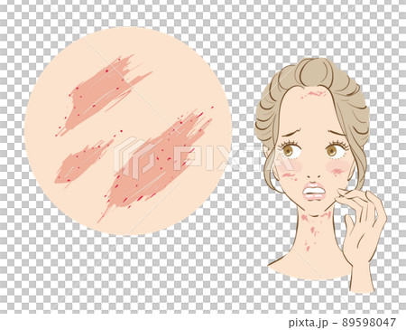 一個患有過敏和敏感皮膚的可愛女人 一個患有過敏和敏感皮膚的可愛女人 89598047