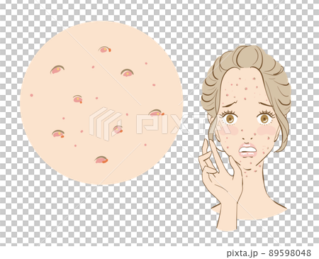 一個患有痤瘡皮膚的可愛女人 89598048