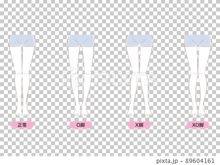 O脚・X脚・XO脚 89604161