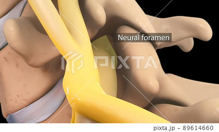 Anatomical view of the cervical spine with intervertebral disc-compressive nerve root prolapse Anatomical view of the cervical spine with intervertebral disc-compressive nerve root prolapse 89614660