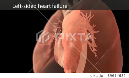 illustration Congestive Heart Failure illustration Congestive Heart Failure 89614682
