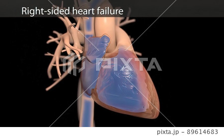 illustration Congestive Heart Failure illustration Congestive Heart Failure 89614683