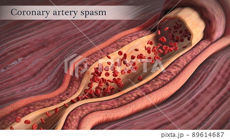 Coronary artery spasm is a brief, sudden narrowing of one of these arteries. 89614687