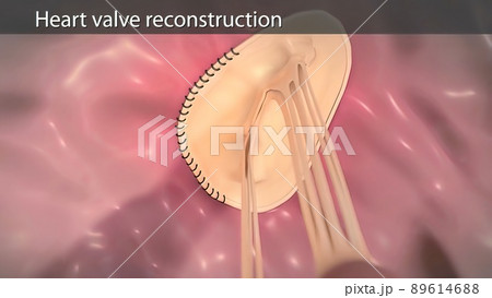 Coronary artery bypass surgery is done using a healthy blood vessel called a graft. Coronary artery bypass surgery is done using a healthy blood vessel called a graft. 89614688