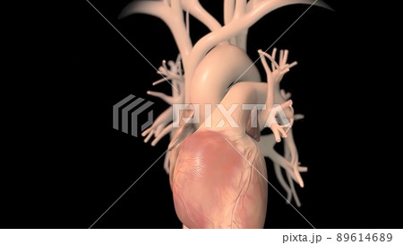 Coronary artery bypass surgery is done using a healthy blood vessel called a graft. Coronary artery bypass surgery is done using a healthy blood vessel called a graft. 89614689