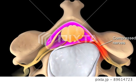 Pressure applied to the nerve as a result of the fracture of the spinal disc Pressure applied to the nerve as a result of the fracture of the spinal disc 89614723
