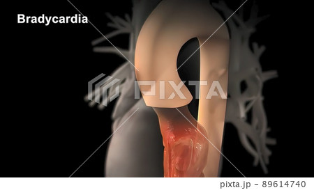 Bradycardia: This means a slow heartbeat - resting heart rate of less than 60 beats per minute 89614740