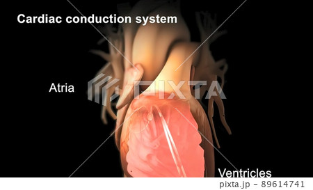 Catheter ablation is the treatment of arrhythmia with radio waves. 89614741