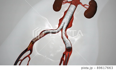 balloon angioplasty procedure with stent in vein 89617663