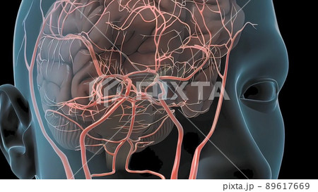 Cerebral hemorrhage as a result of an aneurysm bursting in the brain Cerebral hemorrhage as a result of an aneurysm bursting in the brain 89617669