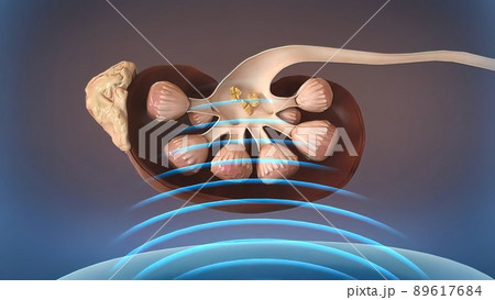 Kidney lithotripsy procedure Etracorporeal shock wave lithotripsy for remove Kidney lithotripsy procedure Etracorporeal shock wave lithotripsy for remove 89617684