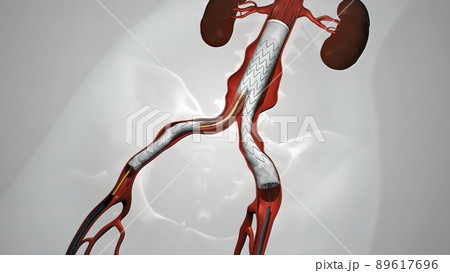 balloon angioplasty procedure with stent in vein 89617696