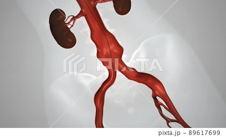 balloon angioplasty procedure with stent in vein balloon angioplasty procedure with stent in vein 89617699