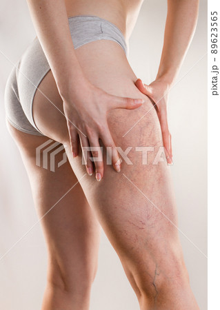 Medicine and varicose veins. A young woman of athletic build clutches her leg with a varicose mesh on her thigh. Vertical orientation Medicine and varicose veins. A young woman of athletic build clutches her leg with a varicose mesh on her thigh. Vertical orientation 89623565