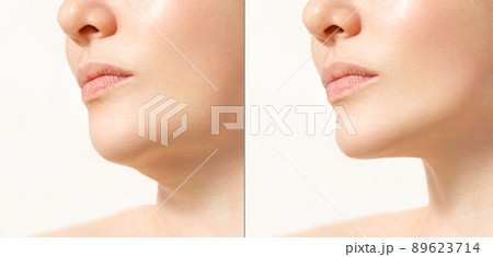 Female double chin before and after correction. Correction of the chin shape liposuction of the neck. The result of the procedure in the clinic of aesthetic medicine. 89623714